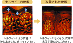 セルライトの状態 セルライトにより皮膚が持ち上げられ、波打っています。改善された状態　セルライトがなくなり、皮膚の表面が滑らかになります。